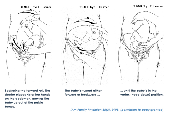 Doula Helps Version Breech